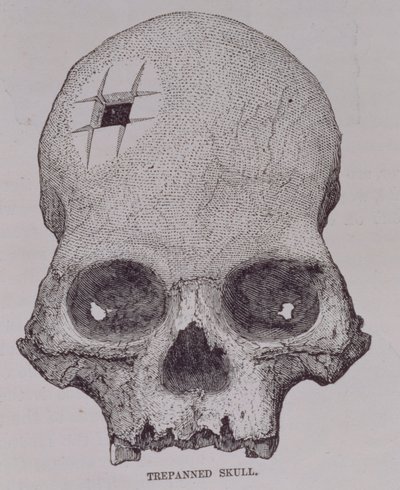 Trepannierter Schädel, aus 
